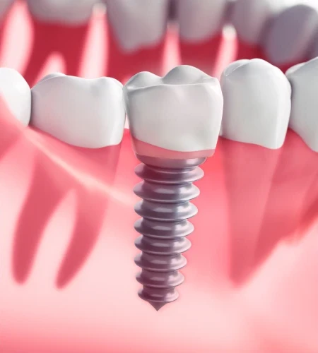 Dental implant restoration showing natural-looking replacement tooth in Billings, MT